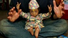 18-Year-Old Only Two-Feet Tall, Weighs 10 lbs